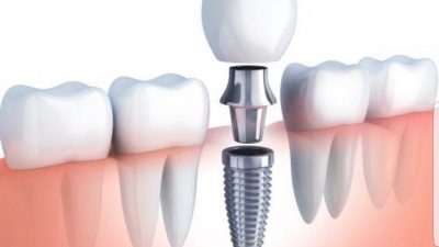 PROMO artDENTAL Priprema za zubni implantat – sve što trebate znati